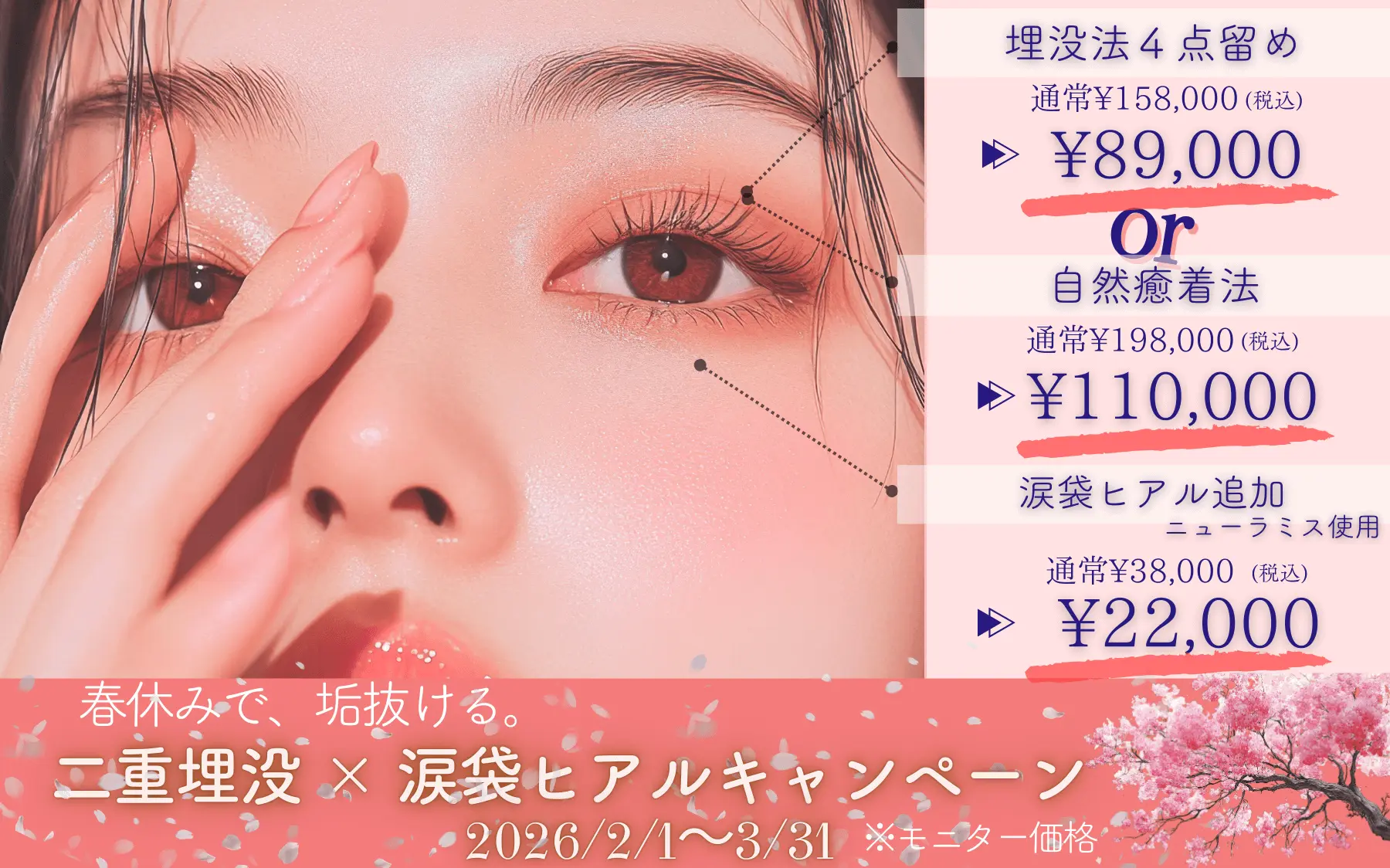 春休みで垢抜ける　二重埋没×涙袋ヒアルキャンペーン