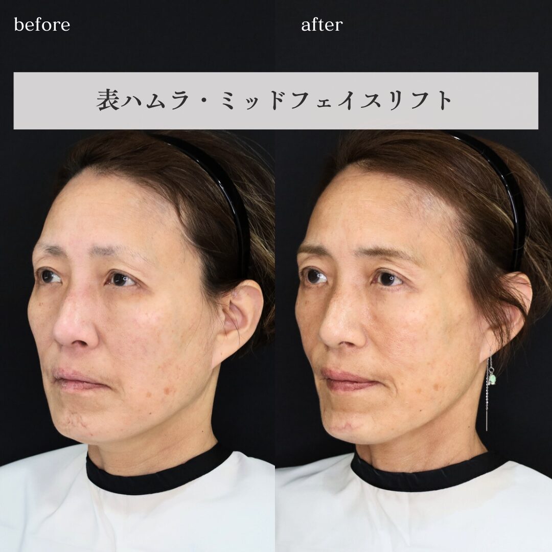 輪郭（テスト）Before写真