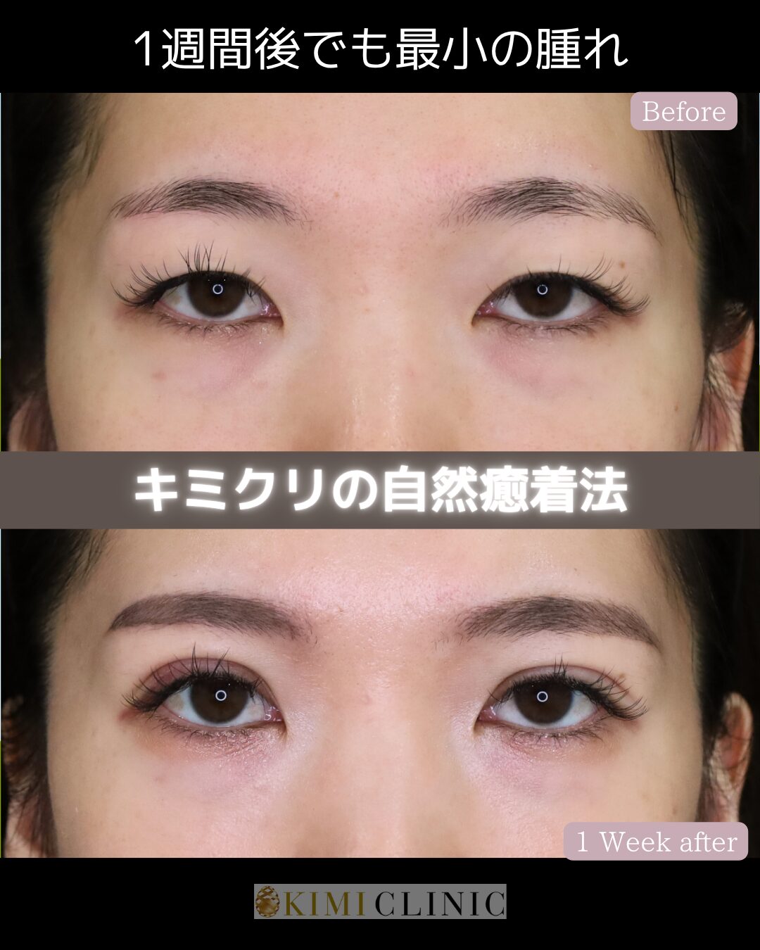 「自然癒着法」のダウンタイム経過Before写真