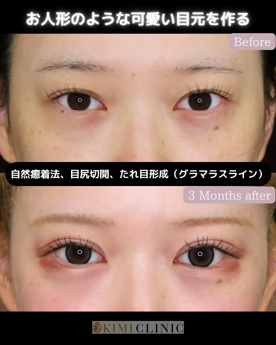 瞼の複合手術「自然癒着法×目尻切開・たれ目形成（グラマラスライン）」の術前・術後比較Before写真