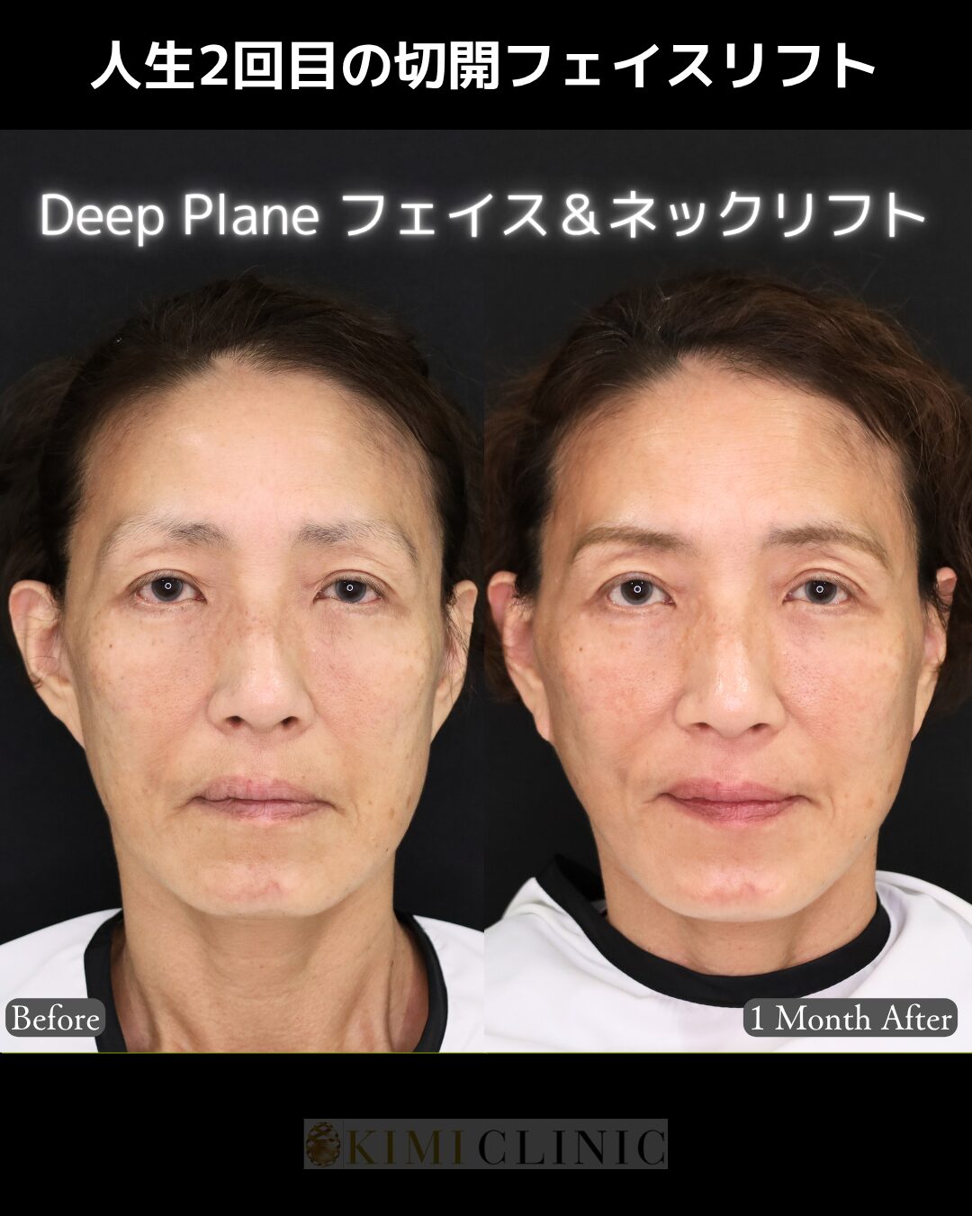 「フェイス＆ネックリフト(Deep plane法）」の術前・術後比較Before写真