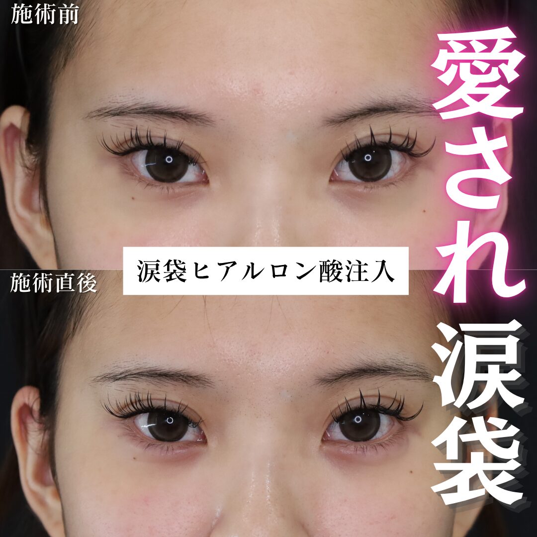 ヒアル症例投稿サンプルBefore写真