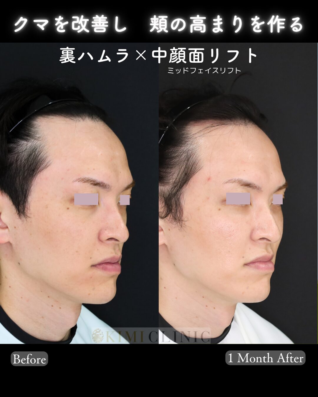 「裏ハムラ×中顔面（ミッドフェイス）リフト」の術前・術後比較Before写真