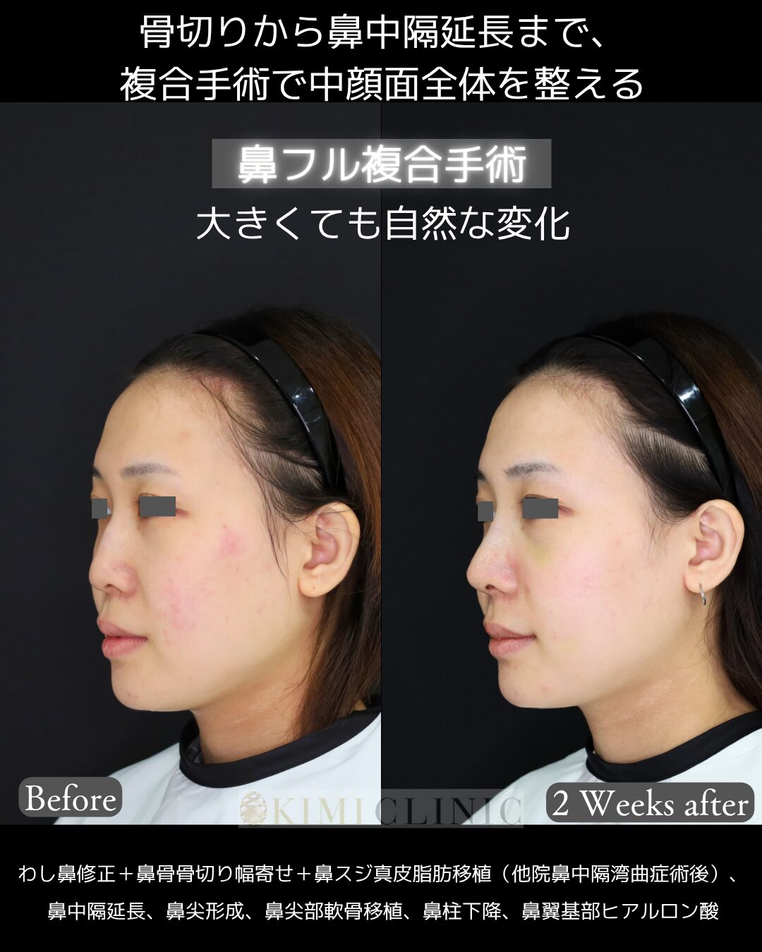 「鼻フル複合手術」の２週間後Before写真