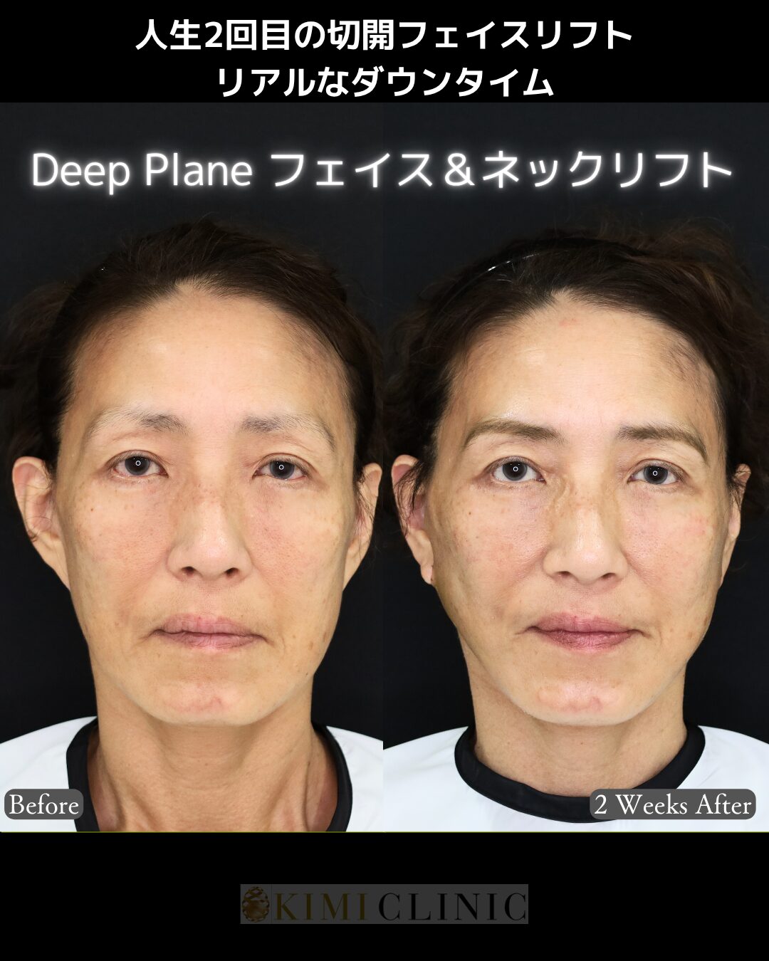 「フェイス＆ネックリフト(Deep plane法）」の1週間後ダウンタイムBefore写真