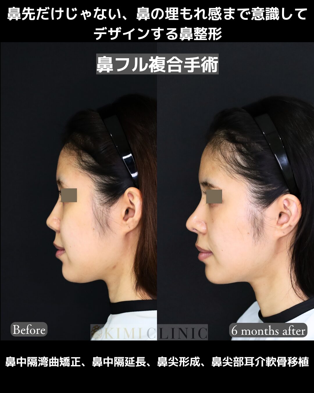 「鼻複合手術」の術前・術後比較Before写真