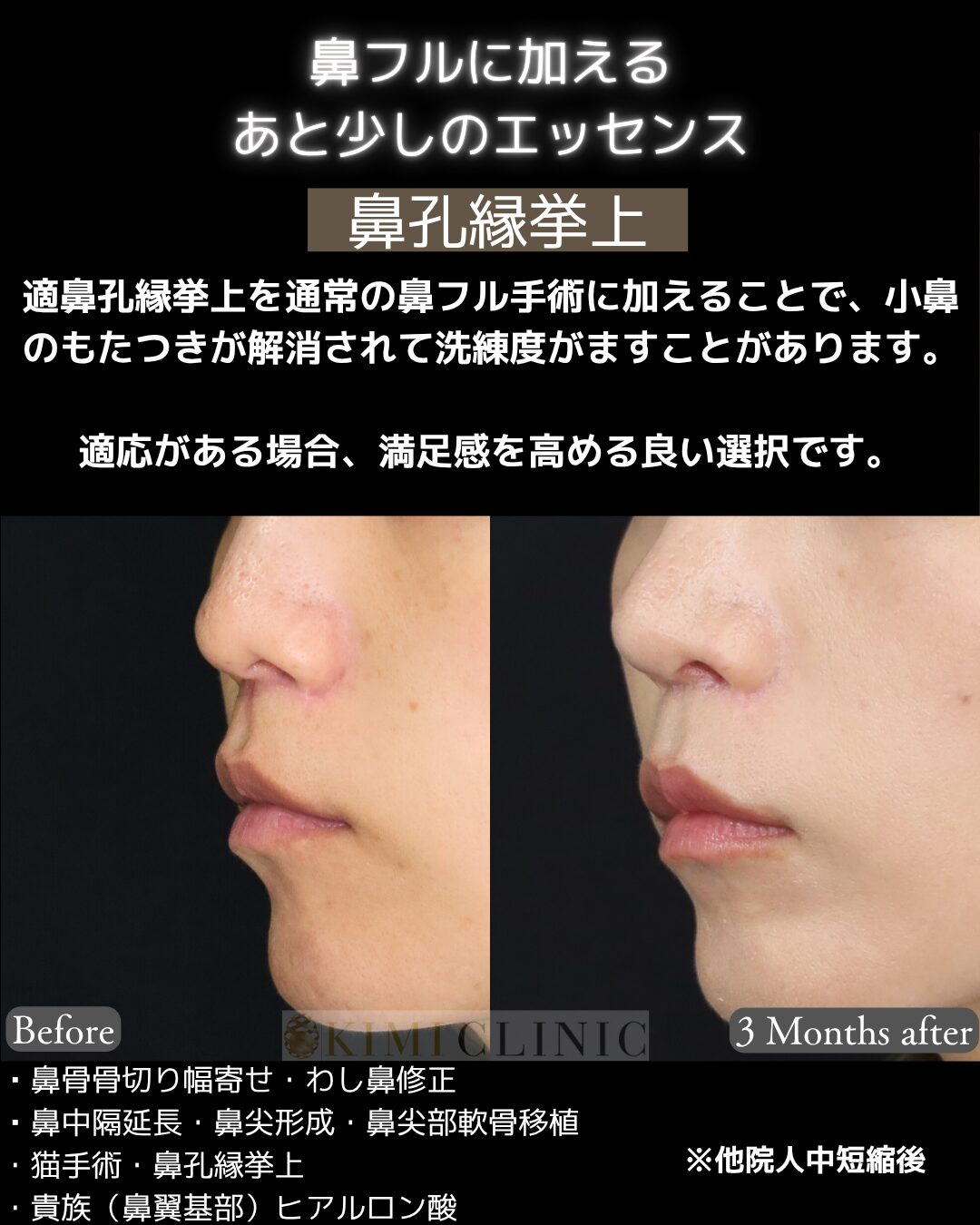 「鼻孔縁挙上」の術前・術後比較Before写真