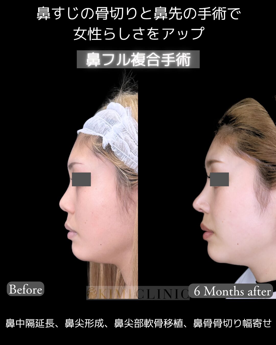 「鼻フル複合手術」の術前・術後比較Before写真