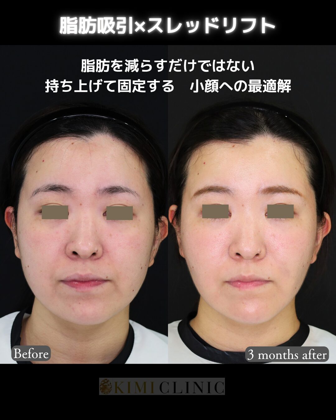 「サクションリフト（顔の脂肪吸引×糸リフト）」の術前・術後比較Before写真