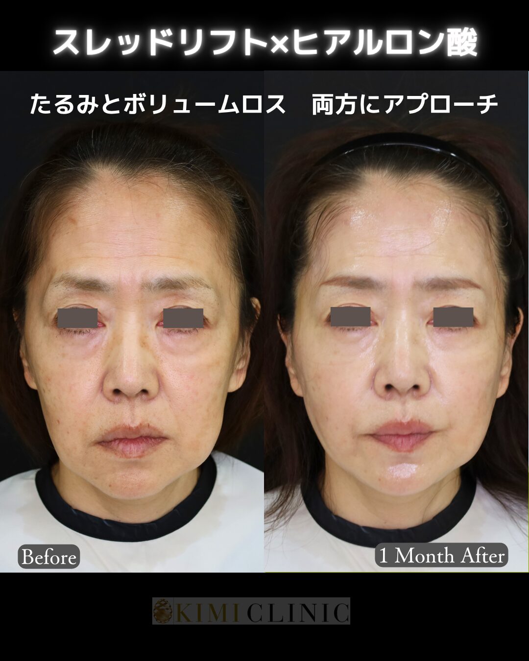 「リフトアップヒアルロン酸 × 糸リフト」の術前・術後比較Before写真