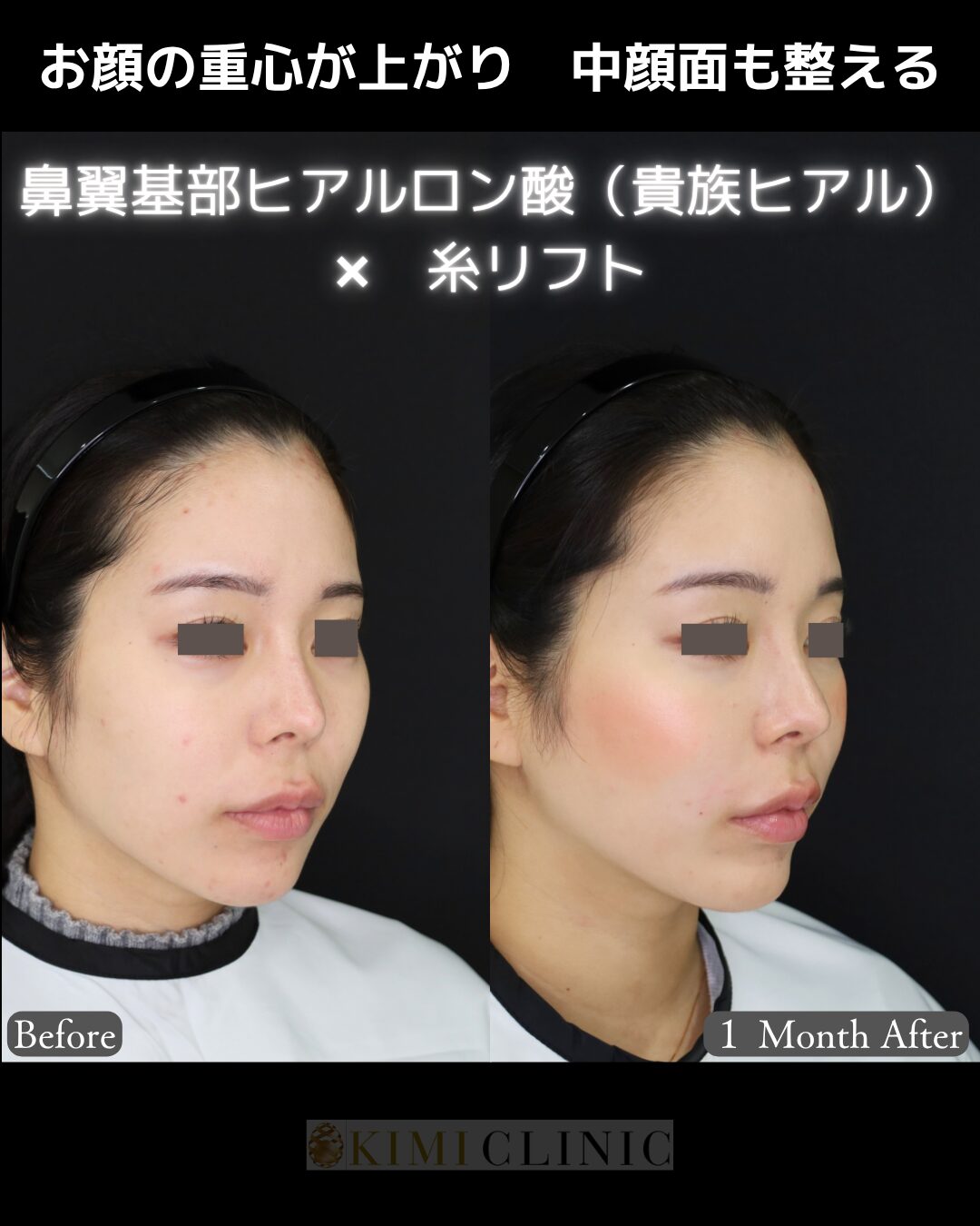 「キミクリ式糸リフト × 貴族ヒアルロン酸」の術前・術後比較Before写真