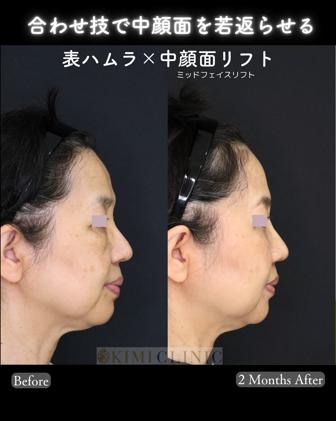 「表ハムラ × 中顔面（ミッドフェイス）リフト」の術前・術後比較Before写真
