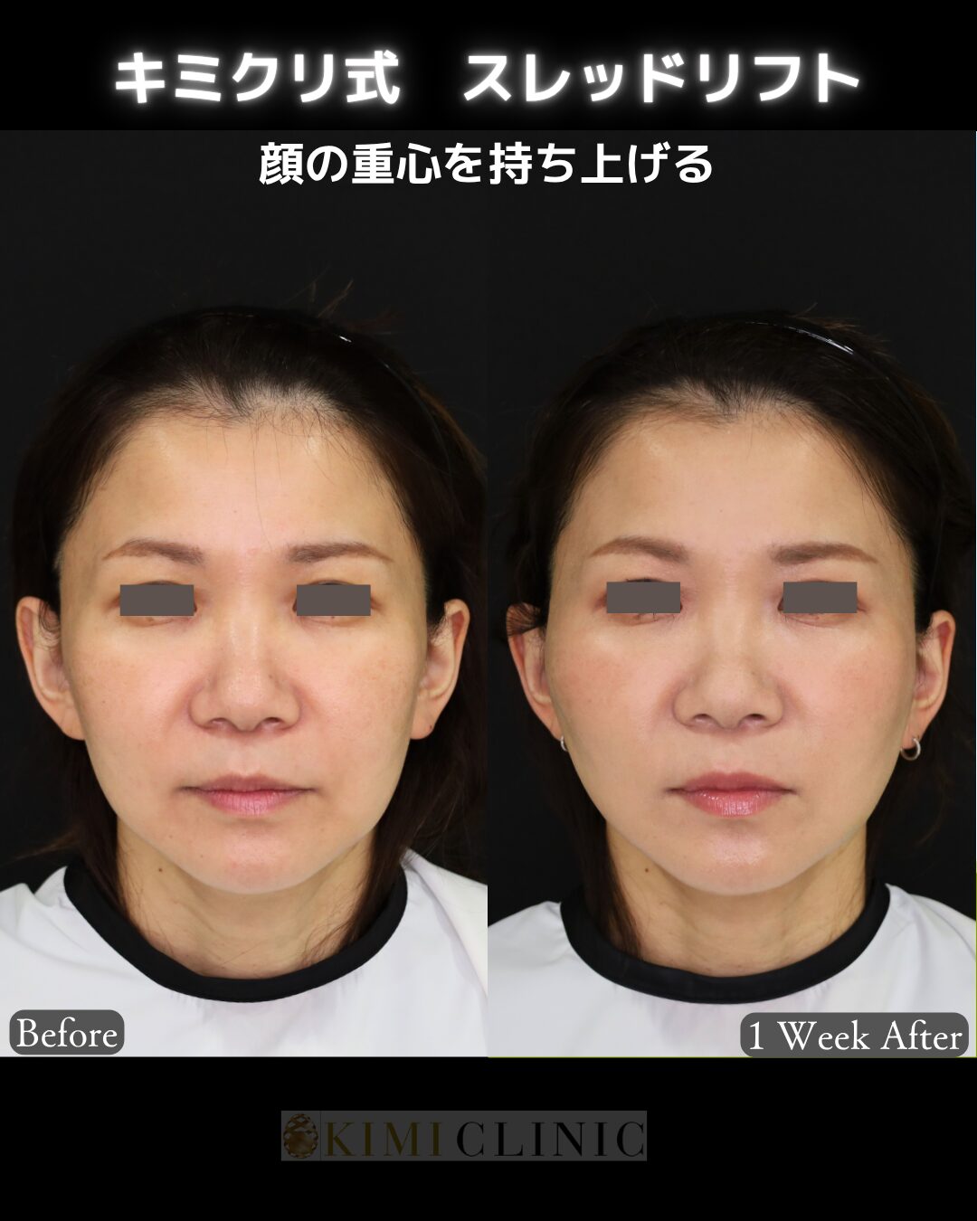 「キミクリ式糸リフト」の術前・術後比較Before写真