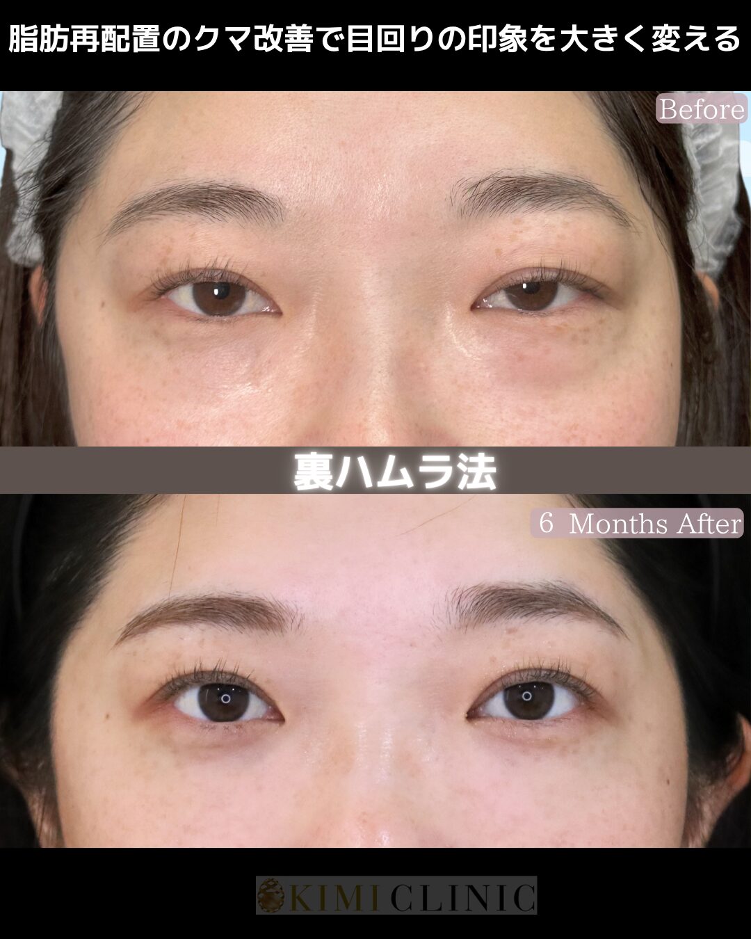 「裏ハムラ法」の術前・術後比較Before写真