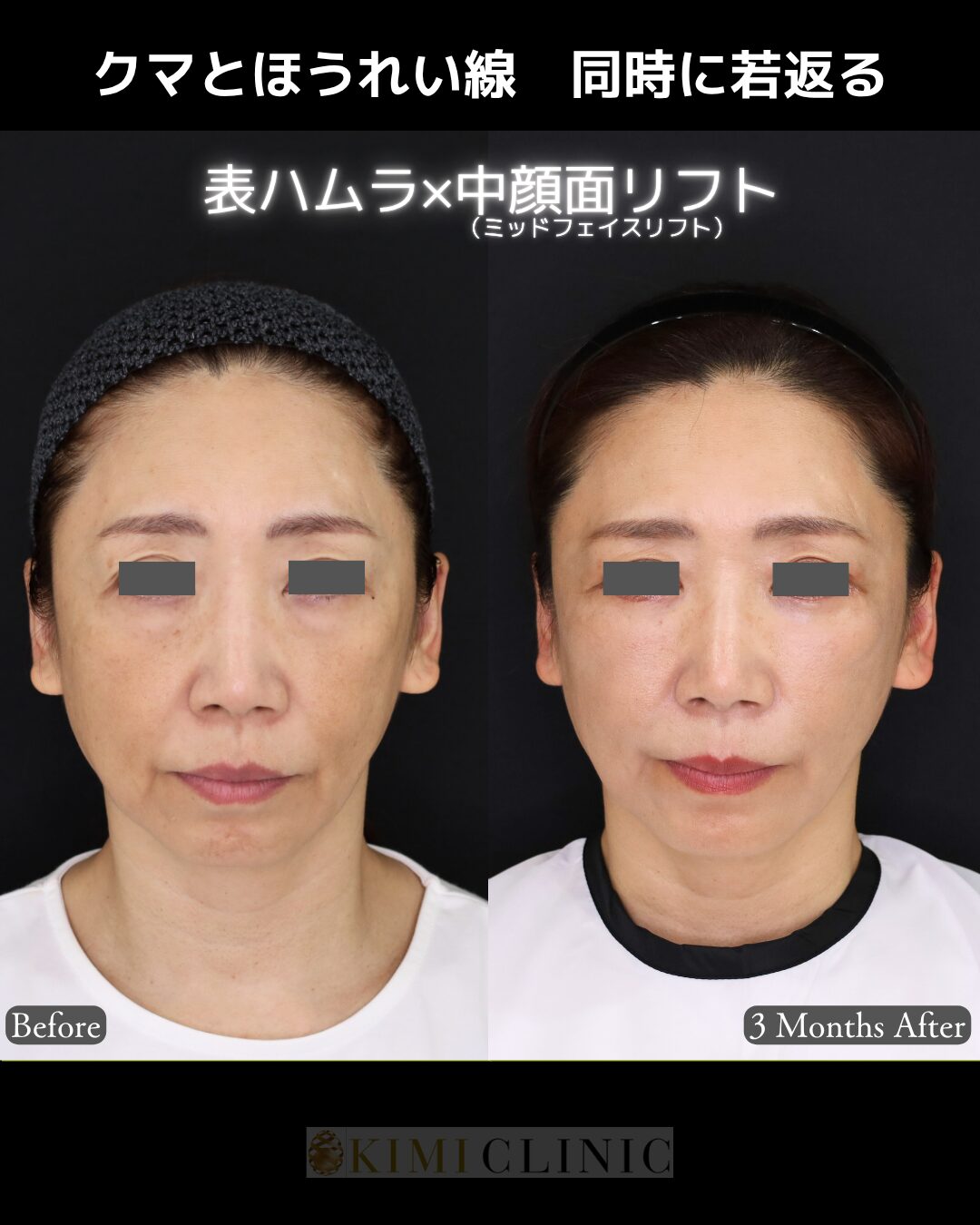 「表ハムラ × ミッドフェイス（中顔面）リフト」の術前・術後比較Before写真