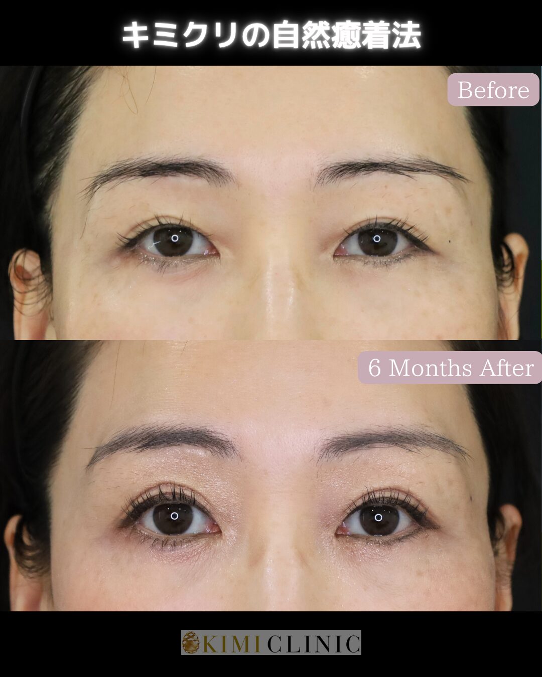 「キミクリの自然癒着法」の術前・術後比較Before写真