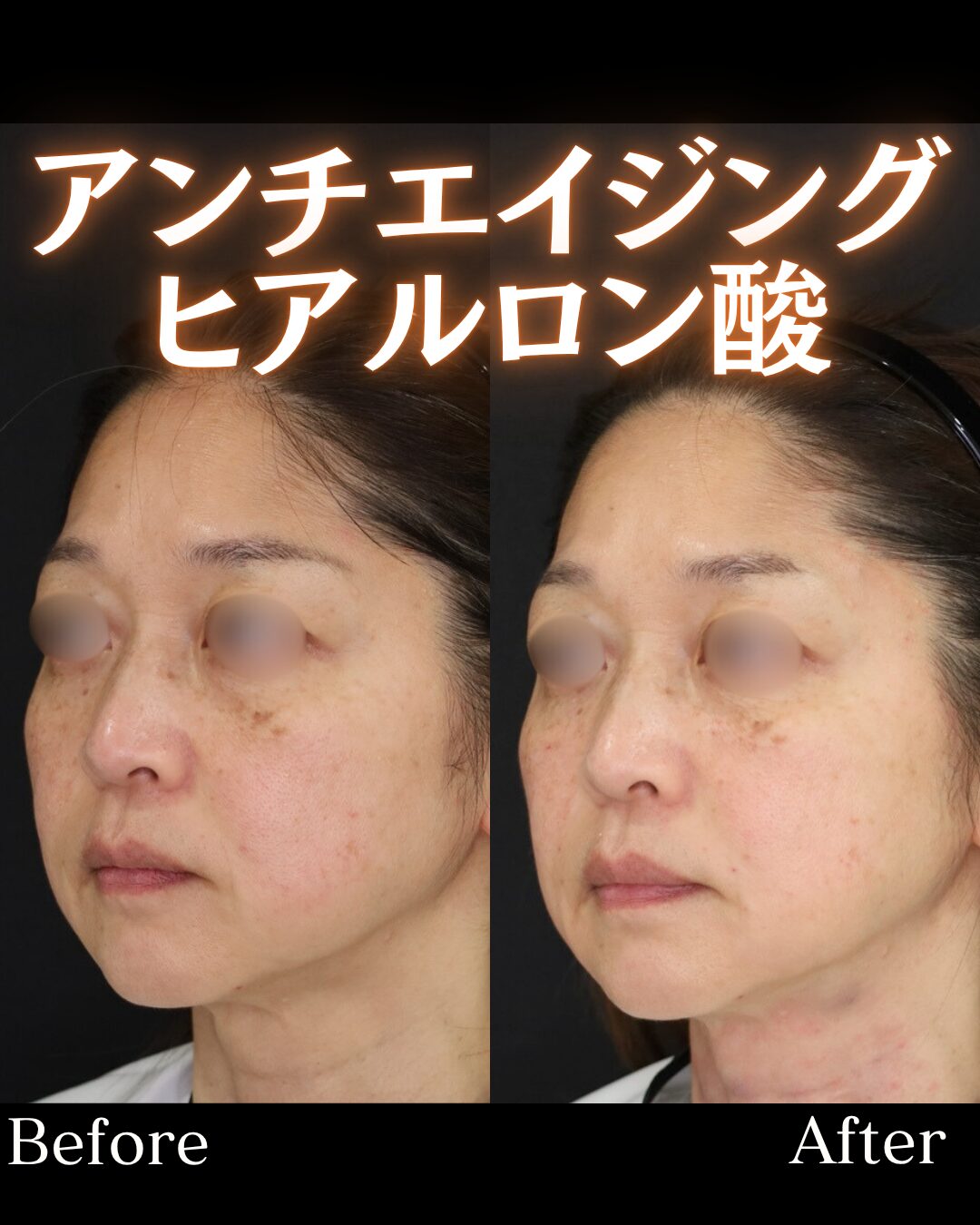 「リフトアップヒアルロン酸」の術前・術後比較Before写真