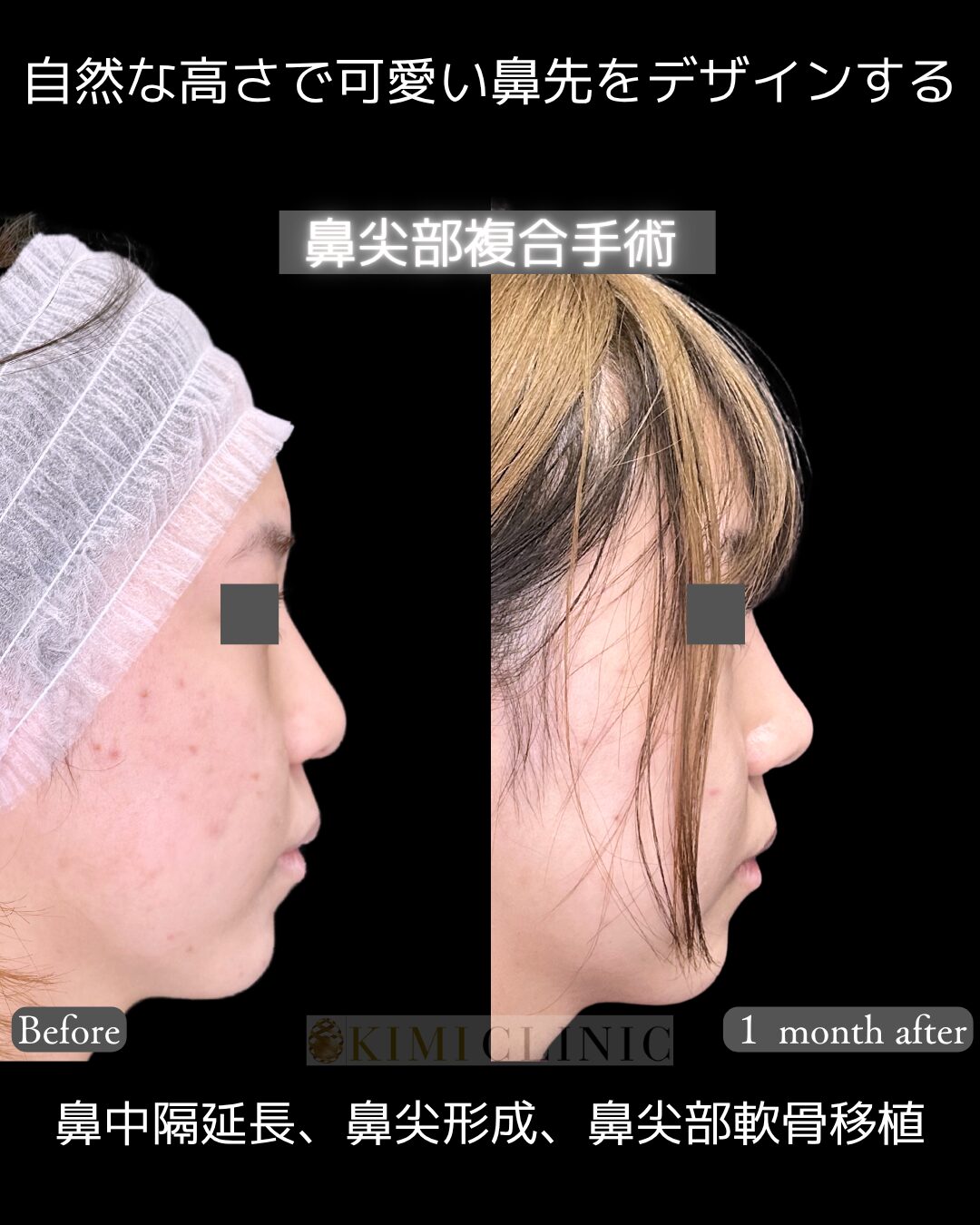 「鼻先の複合手術」の術前・術後比較Before写真