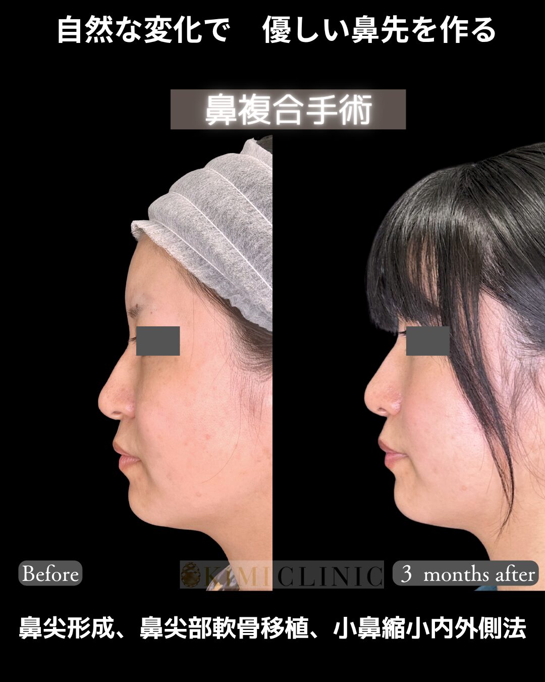 「鼻先、小鼻の複合手術」の術前・術後比較Before写真