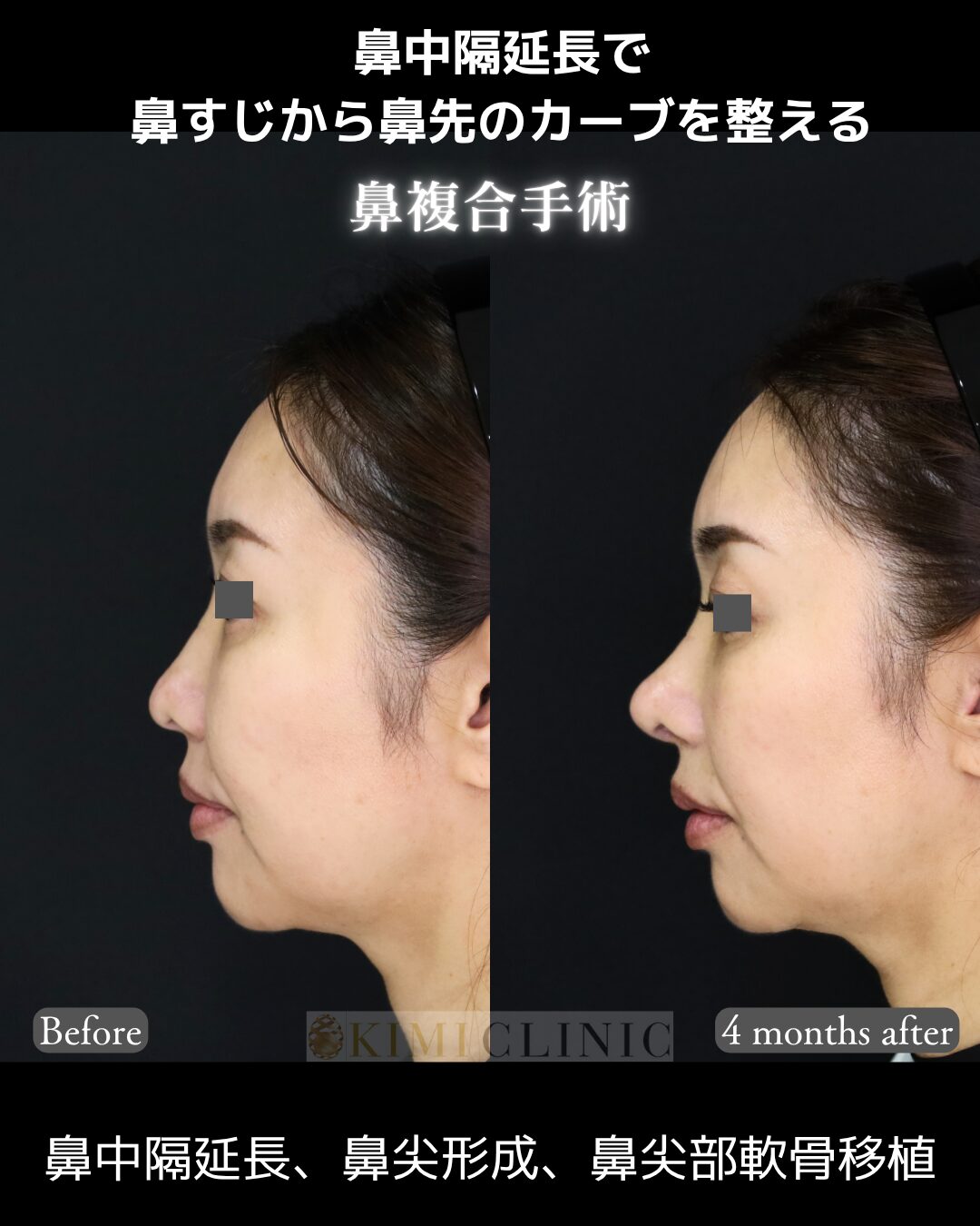 「鼻尖部複合手術」の術前・術後比較Before写真