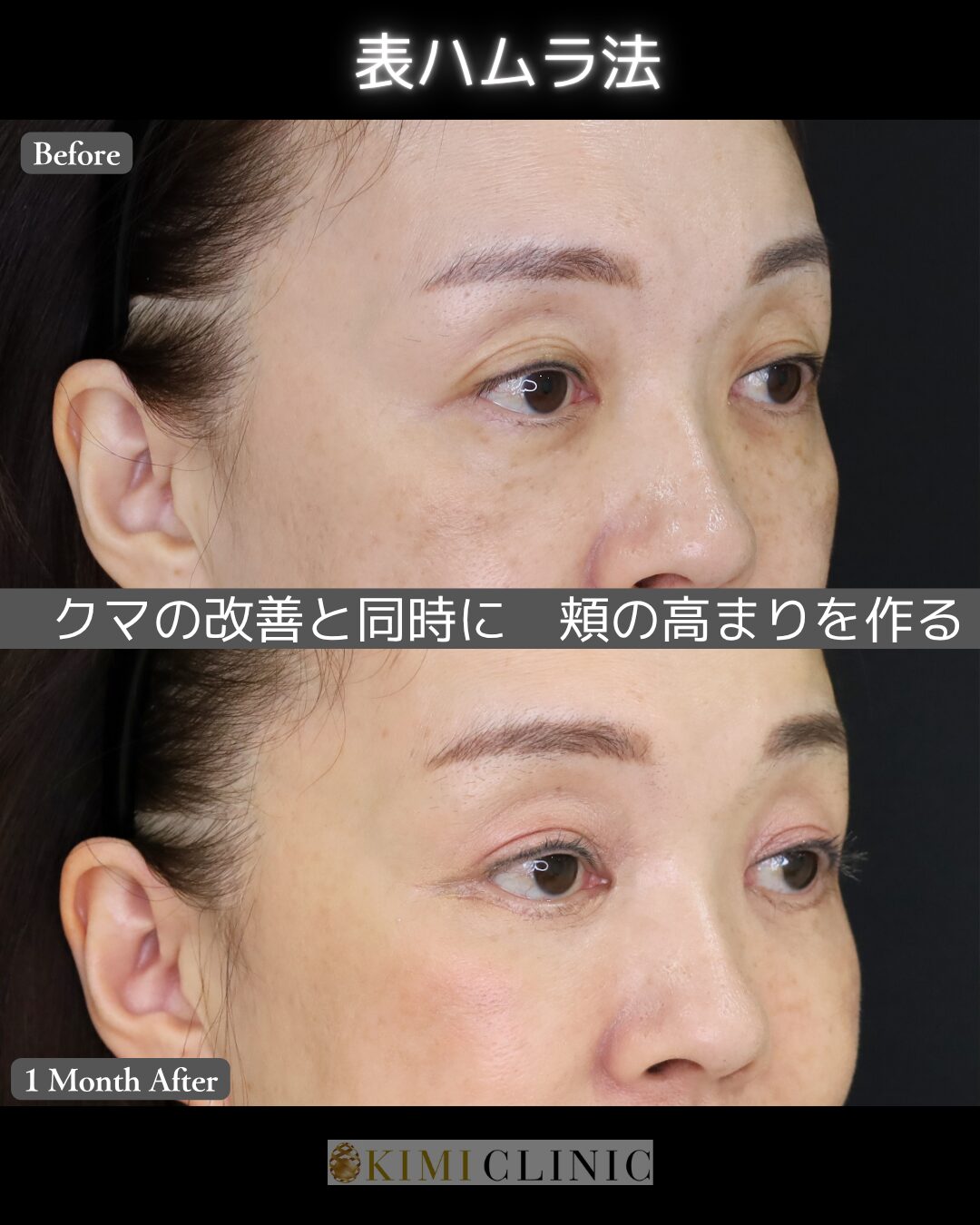 「表ハムラ × 中顔面（ミッドフェイス）リフト」の術前・術後比較Before写真