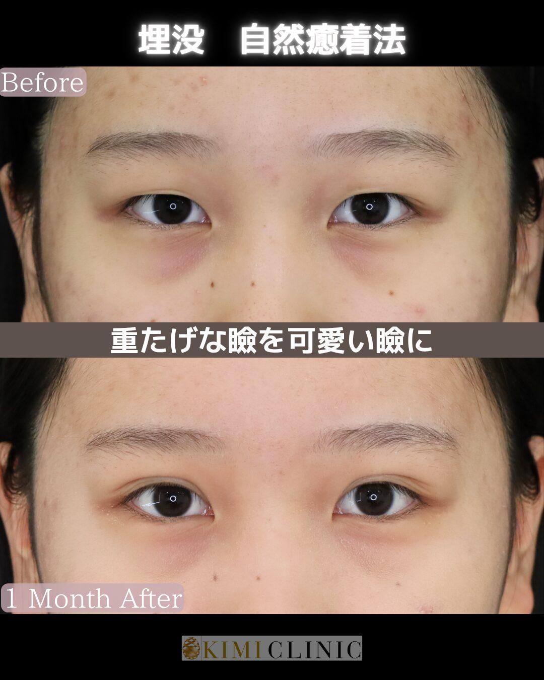 「キミクリの自然癒着法」の術前・術後比較Before写真