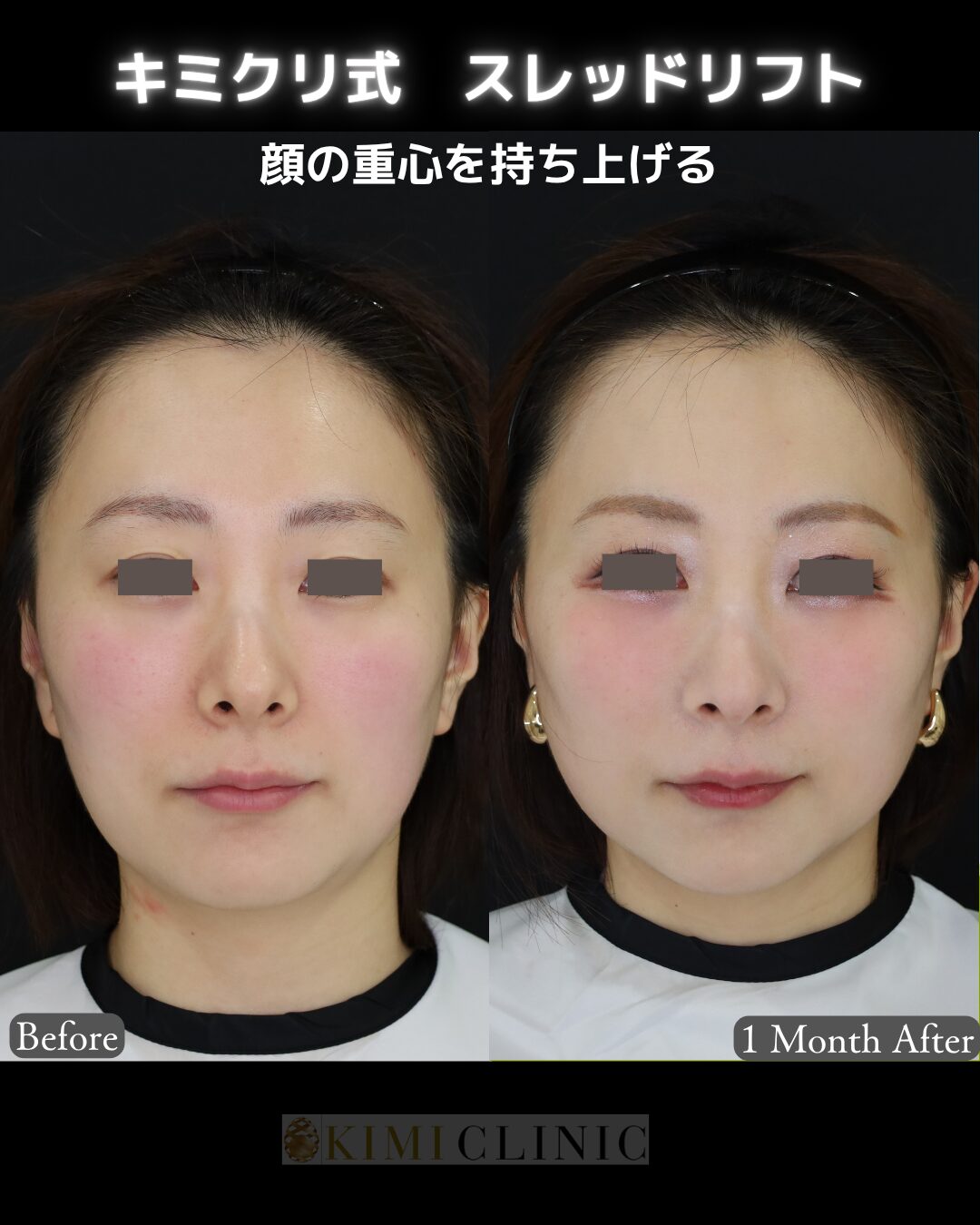 「キミクリ式糸リフト」の術前・術後比較Before写真