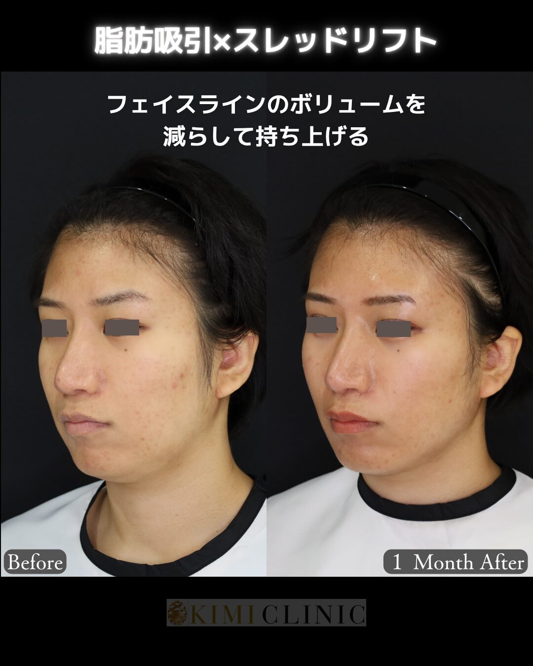 「サクションリフト（脂肪吸引×糸リフト）」の術前・術後比較Before写真