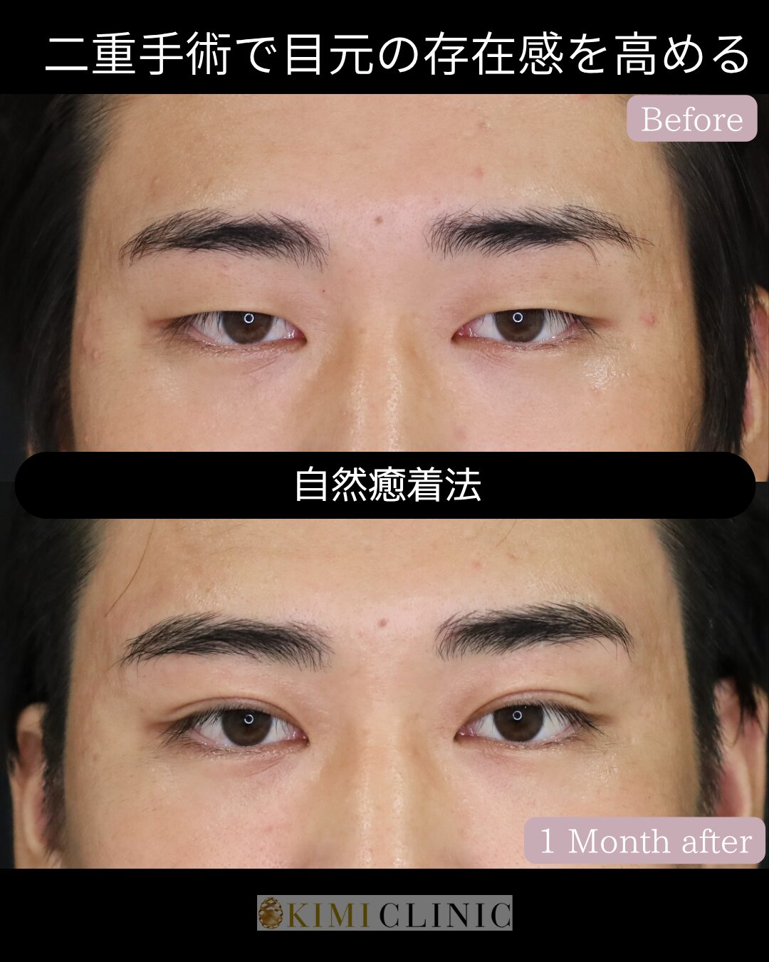 「キミクリの自然癒着法（男性症例）」の術前・術後比較Before写真