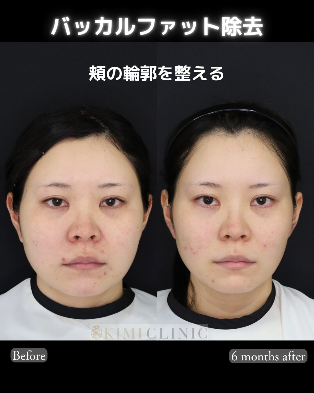 「バッカルファット除去」の術前・術後比較Before写真