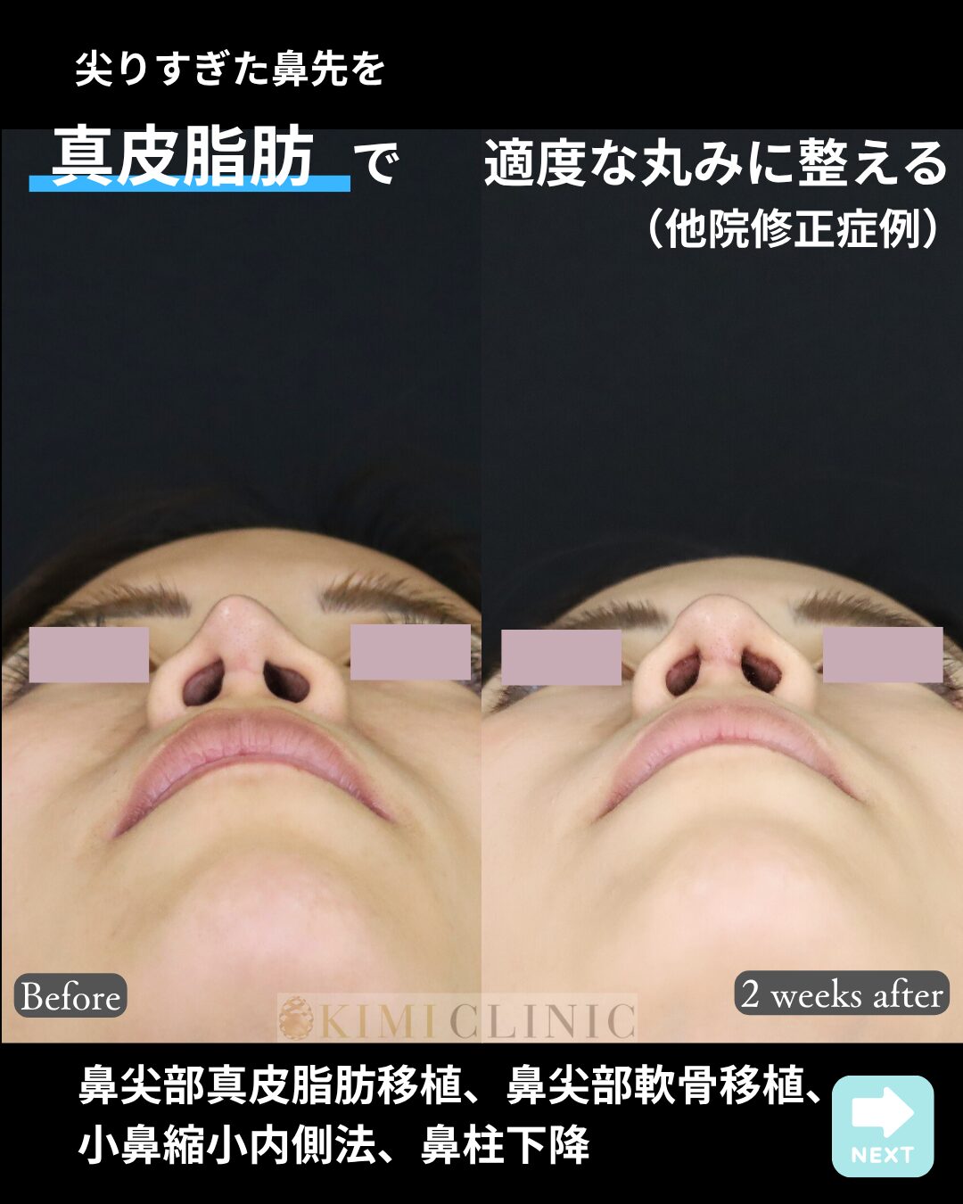 「他院修正　鼻先の真皮脂肪移植・軟骨移植 × 小鼻縮小」の術前・術後比較Before写真