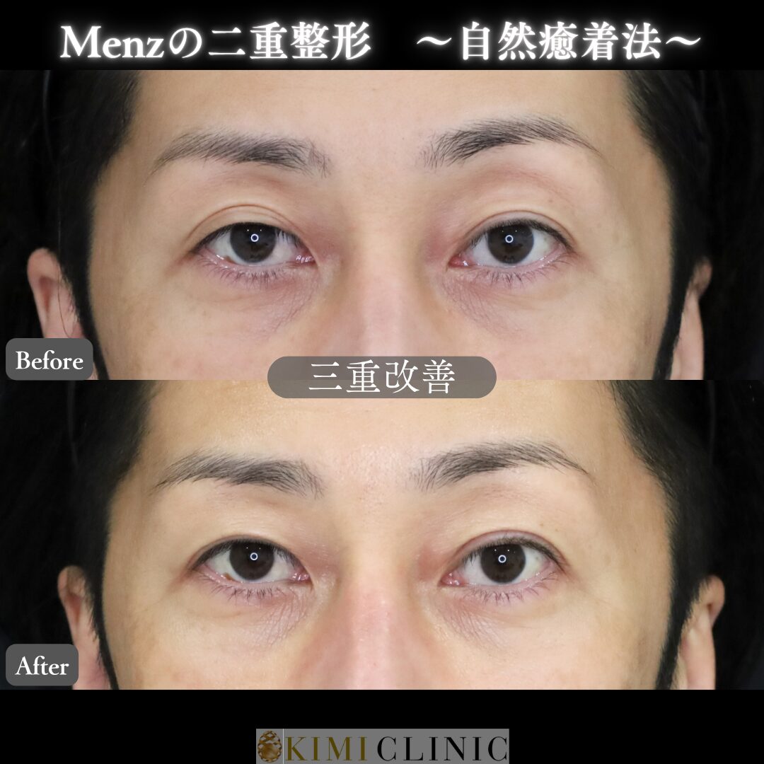 「キミクリの自然癒着法」の術前・術後比較Before写真