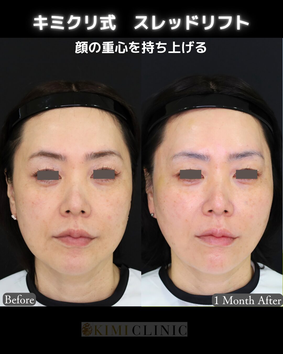 「キミクリ式糸リフト」の術前・術後比較Before写真