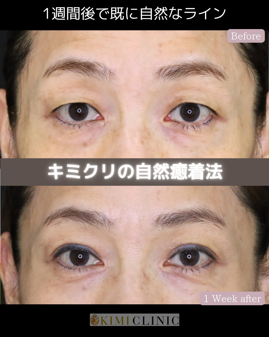 「キミクリの自然癒着法」の術前・術後比較Before写真