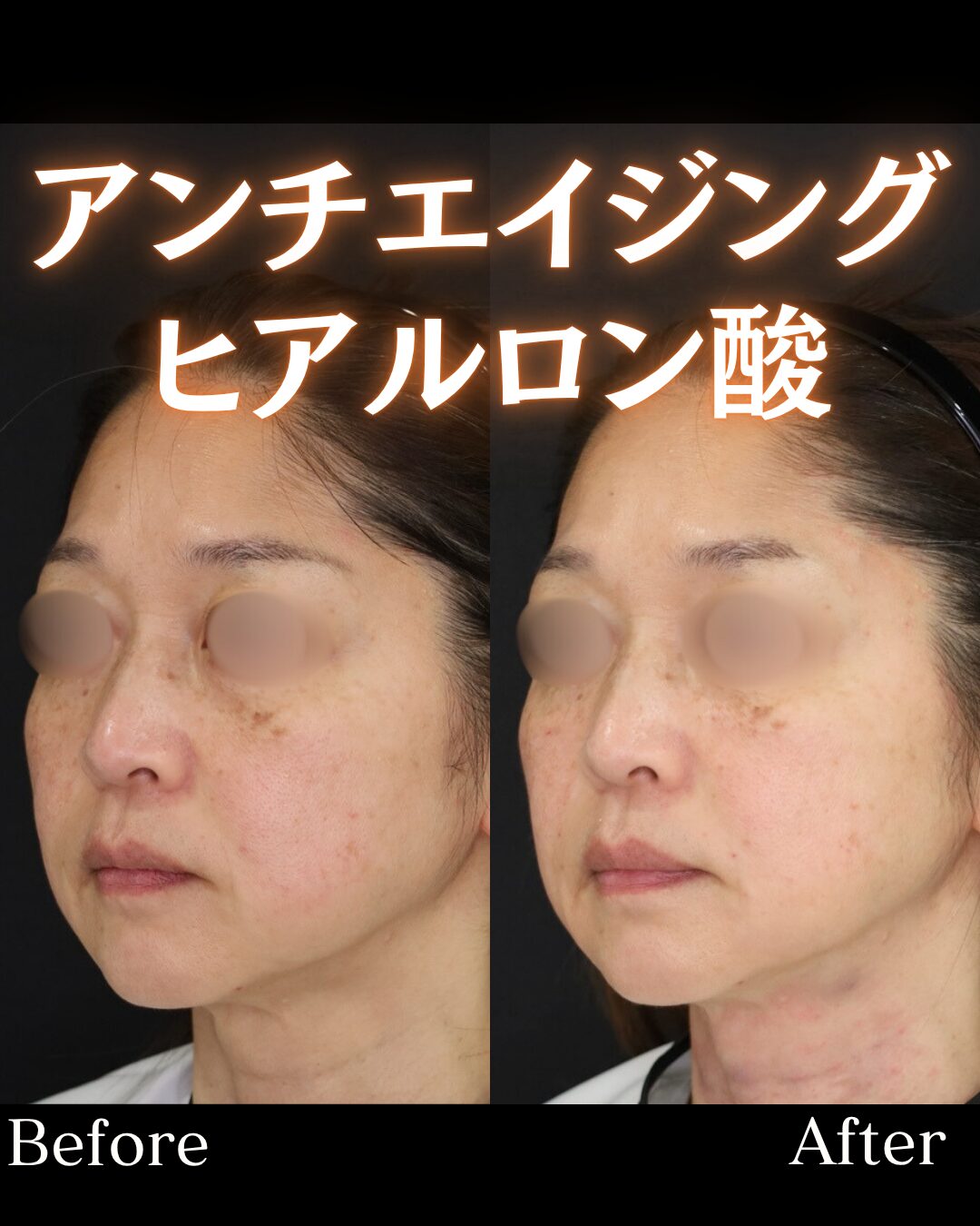 「アンチエイジングヒアル」の術前・術後比較Before写真