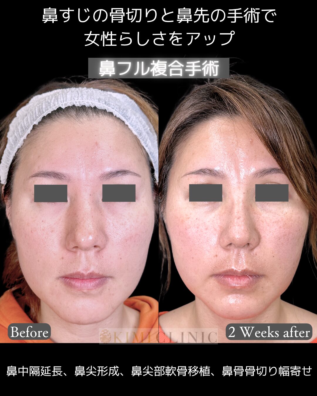 「鼻フル複合手術」の術前・術後比較Before写真