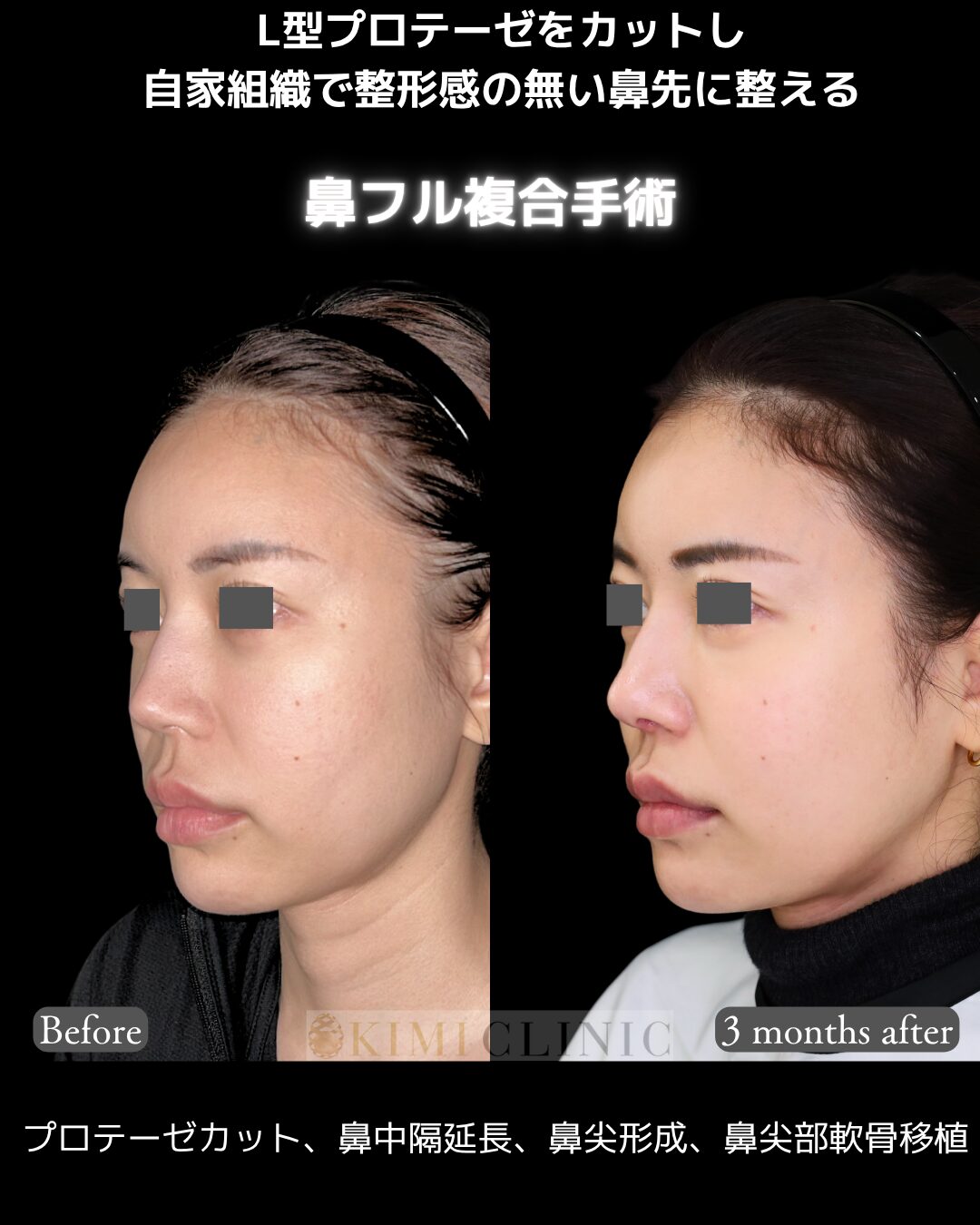 「鼻フル複合手術」の術前・術後比較Before写真