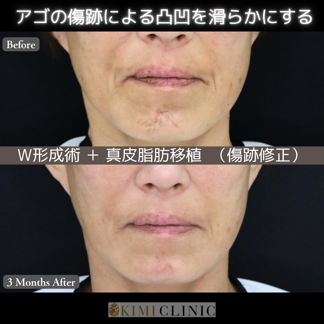 「下あごの傷跡修正（W形成術・真皮脂肪移植）」の術前・術後比較Before写真