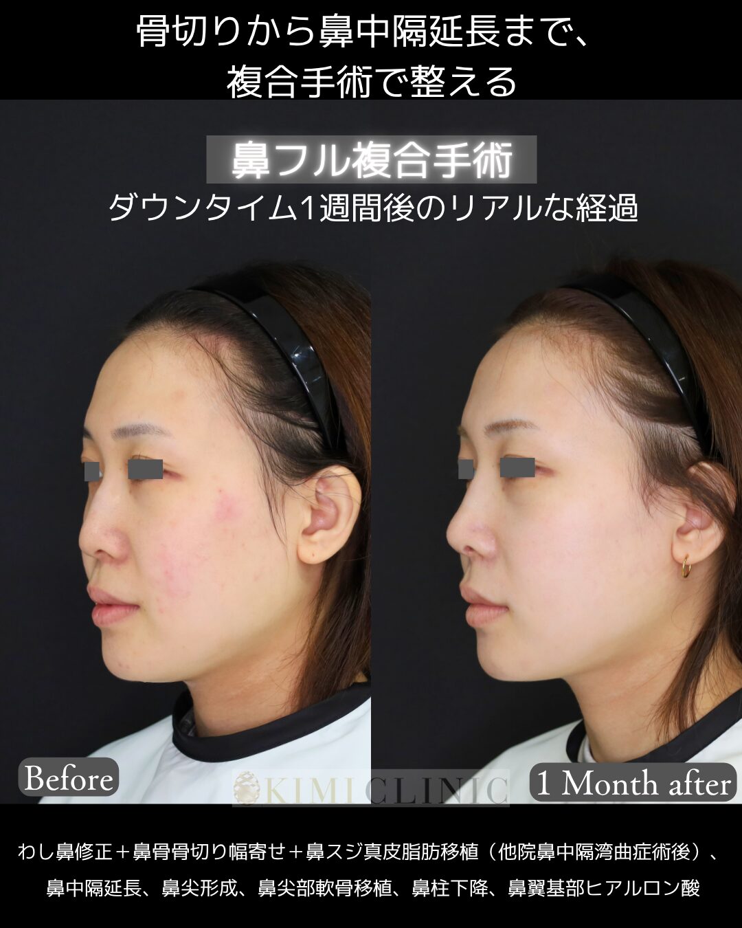 「鼻フル複合手術」の術前・術後比較Before写真