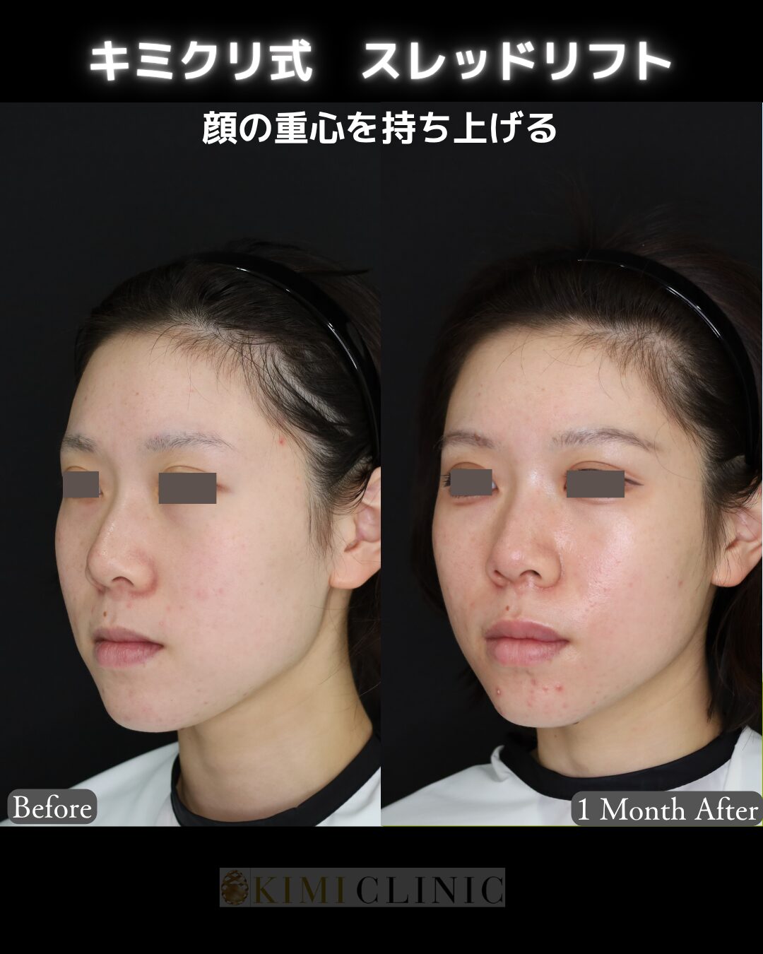 「キミクリ式糸リフト」の術前・術後比較Before写真