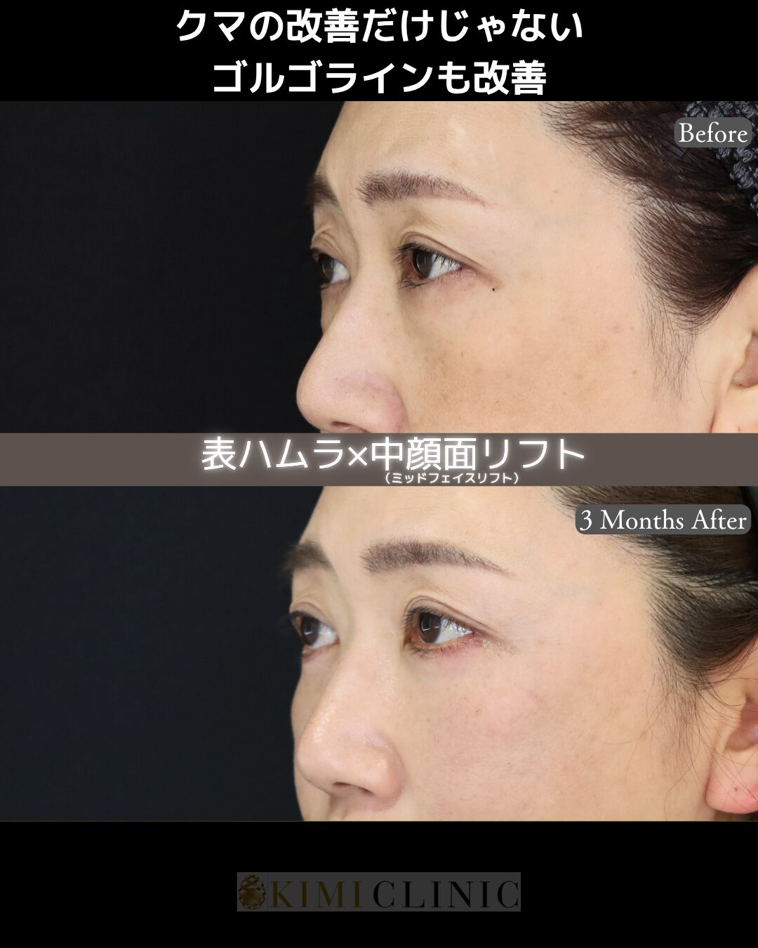 「表ハムラ × ミッドフェイス（中顔面）リフト」の術前・術後比較Before写真