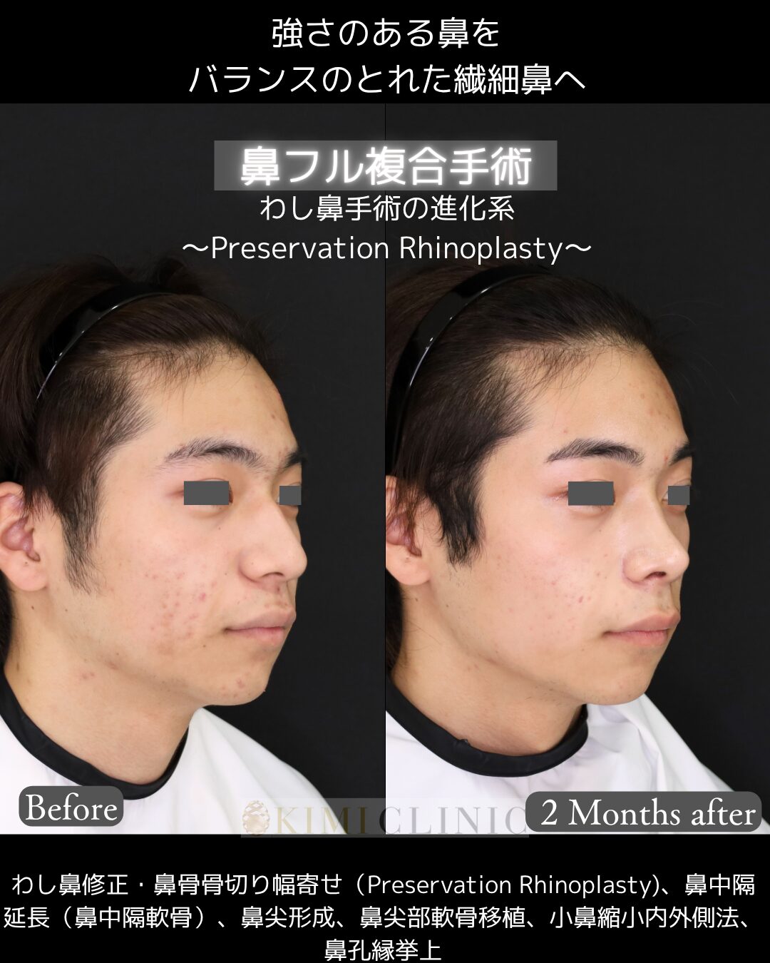 「鼻フル複合手術」の術前・術後比較Before写真