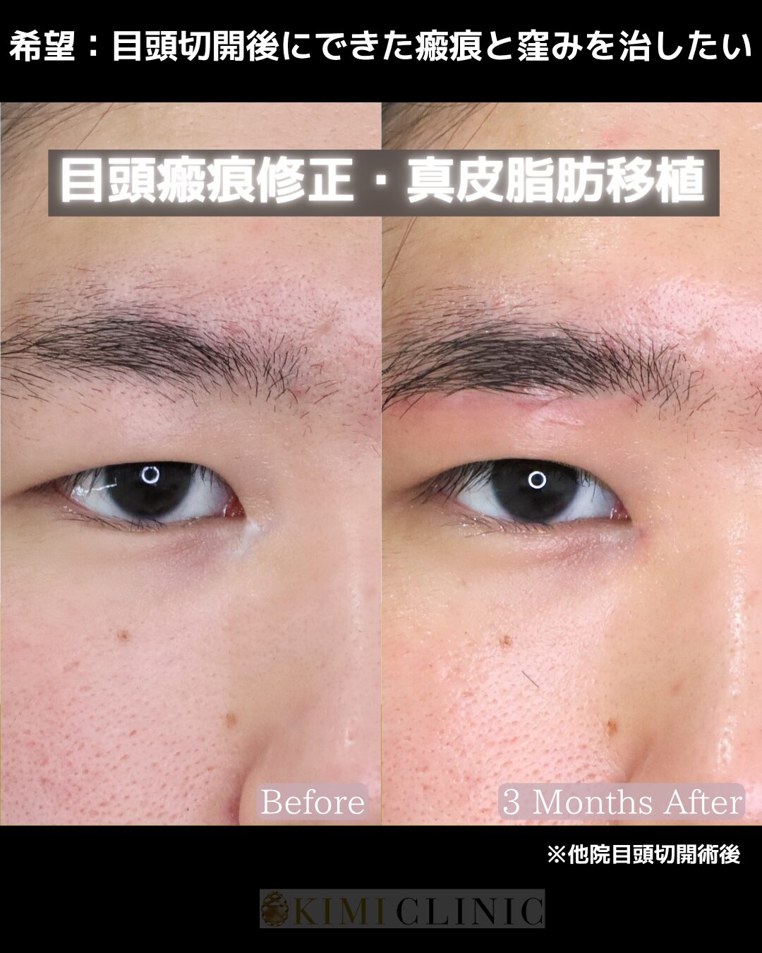 「目頭形成（目頭切開後の窪みと瘢痕改善）・真皮脂肪移植」の術前・術後比較Before写真