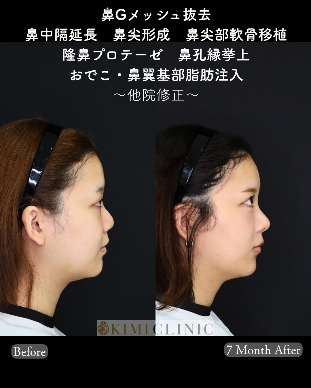 「Gメッシュ除去 × 鼻フル複合手術」の術前・術後比較Before写真