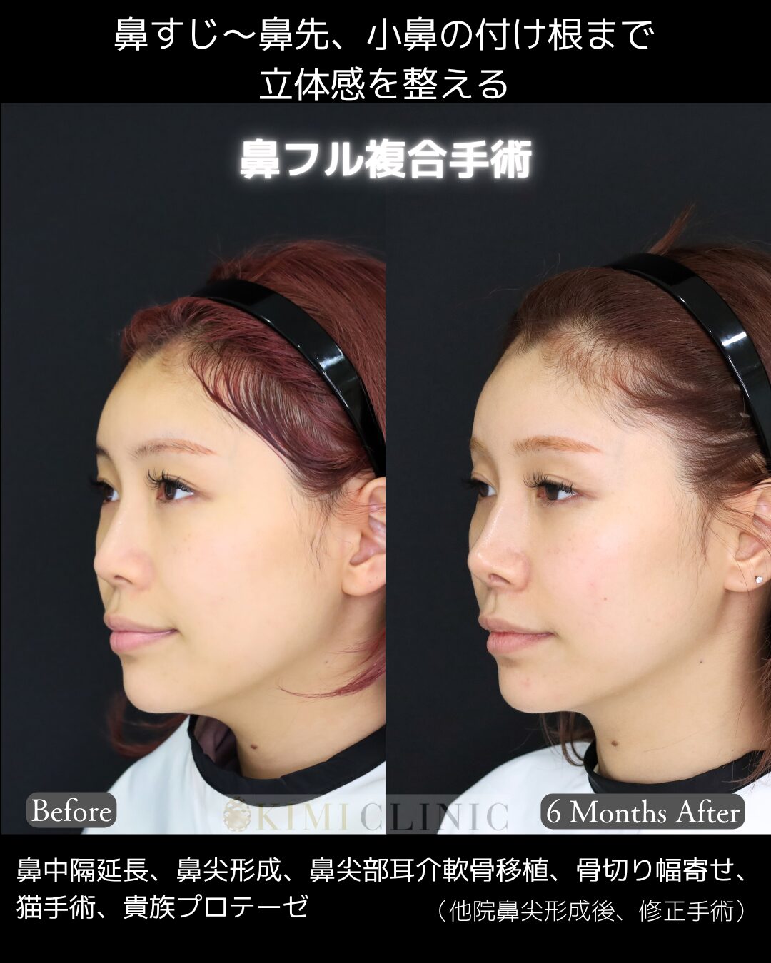 「鼻フル複合手術」の術前・術後比較Before写真