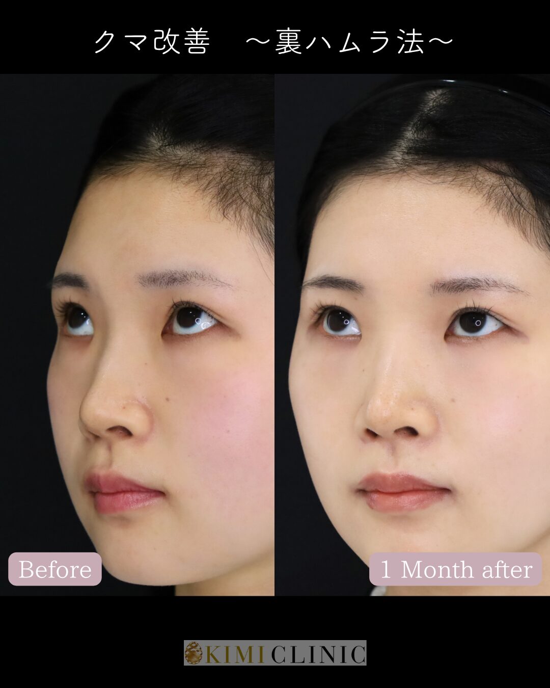 「裏ハムラ法」の術前・術後比較Before写真