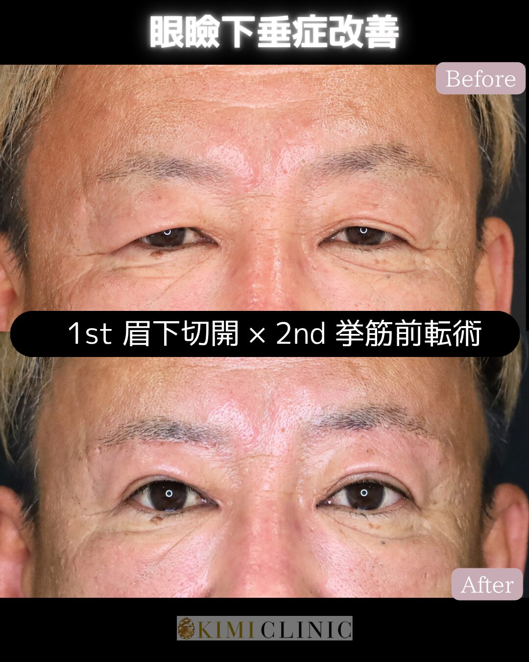 「老人性眼瞼下垂に対する眼瞼下垂手術」の術前・術後比較Before写真