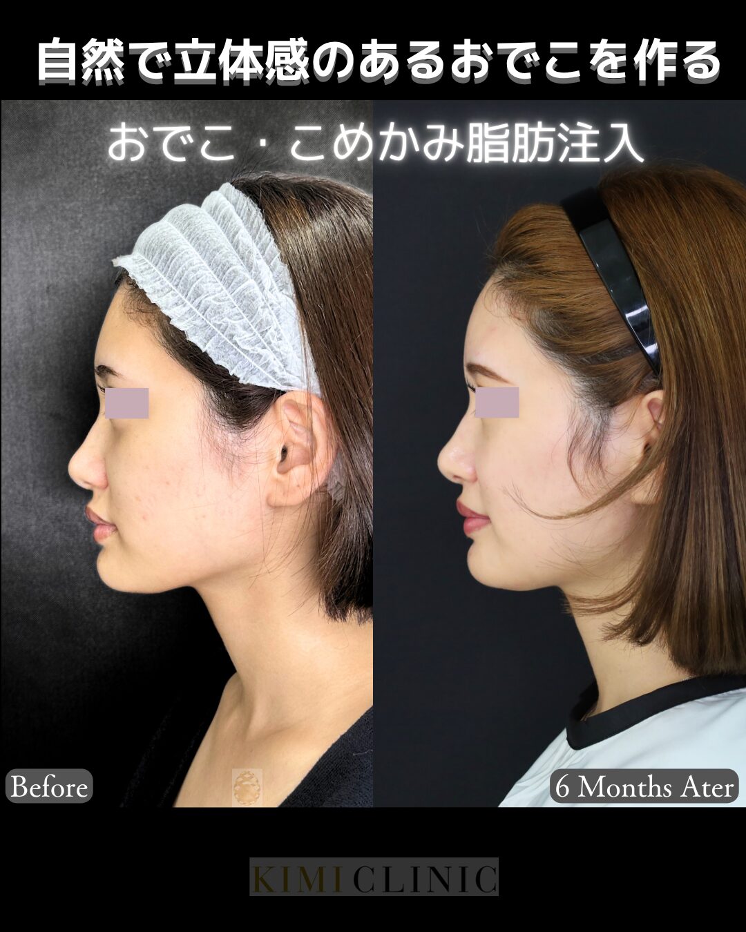 「おでこ、こめかみの脂肪注入」の術前・術後比較Before写真