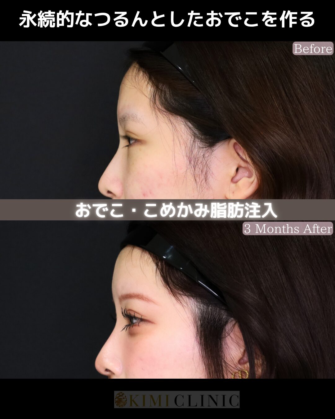 「おでこの脂肪注入」の術前・術後比較Before写真