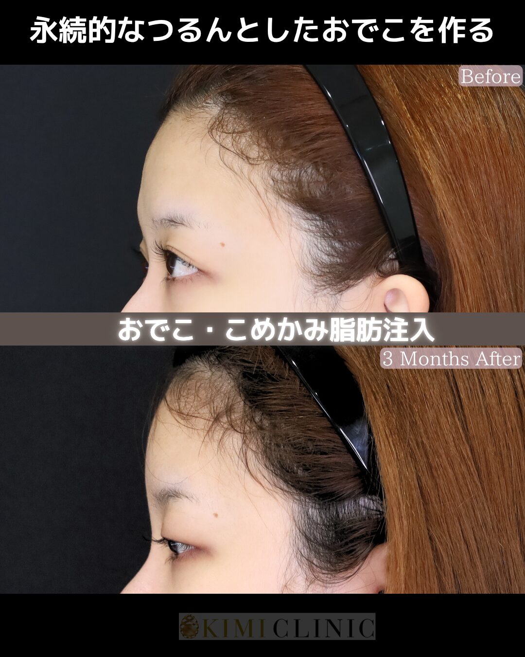 「おでこの脂肪注入」の術前・術後比較Before写真